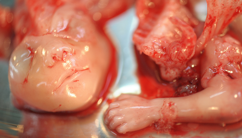 Abortion victim at 15 weeks